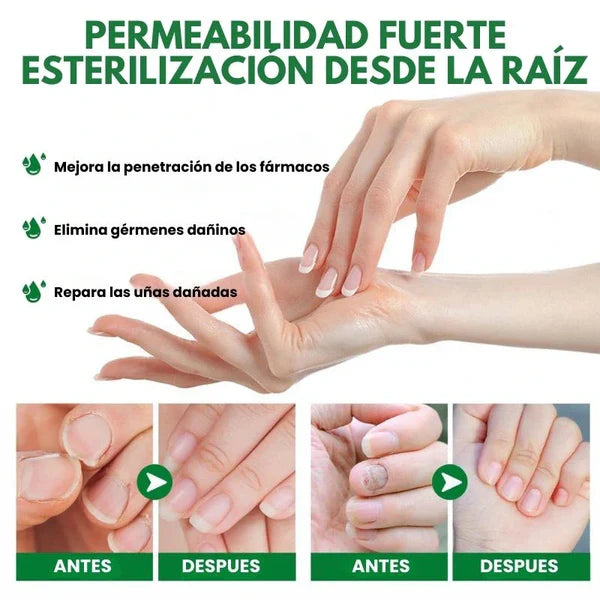 👋🦠Anti Hongos Uñas - 7 Days™  2UND 30ml