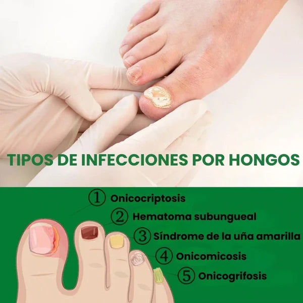 👋🦠Anti Hongos Uñas - 7 Days™  2UND 30ml