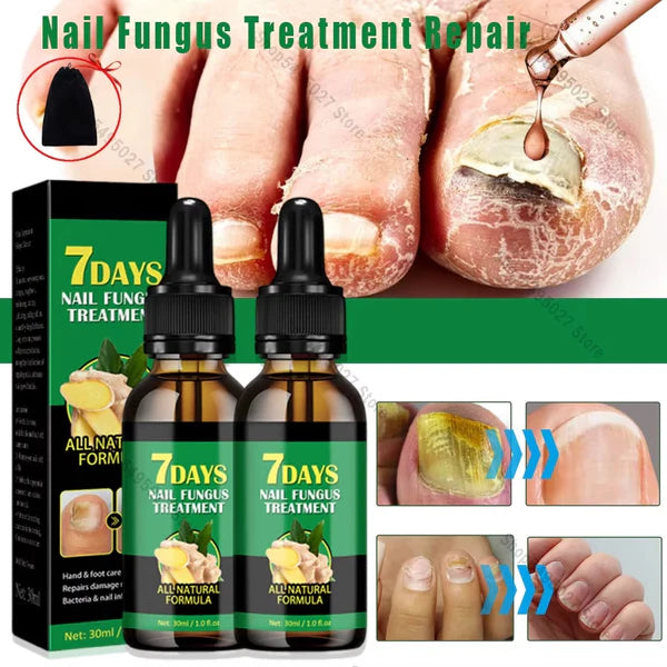 👋🦠Anti Hongos Uñas - 7 Days™  2UND 30ml